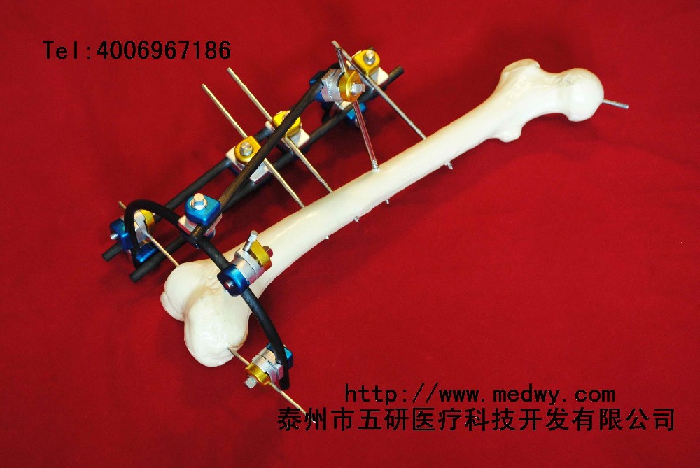 骨折、關(guān)節(jié)炎與四肢畸形患者福音